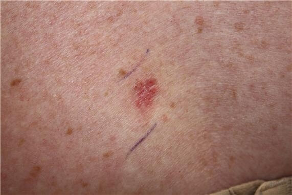 Researchers found that melanoma patients on ipilimamub had an overall survival rate of 11.4 months. (Photo : National Cancer Institute)