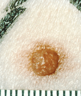 Patients taking BRAF inhibitors are at an increased risk for developin... - See more at: http://www.cancernetwork.com/melanoma/new-melanomas-difficult-detect-patients-treated-braf-inhibitors#sthash.vNyieGdm.dpuf Source: Cancer Network.com