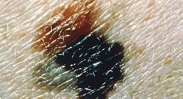 melanoma