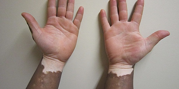 Vitiligo associated with lower incidence of skin cancers