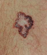 Melanoma with characteristic asymmetry, border irregularity, color var... - See more at: http://www.cancernetwork.com/melanoma/tert-promoter-mutations-common-