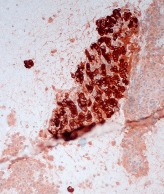 Malignant melanoma, liver FNA; source: Ed Uthman, Wikimedia Commons  Source: Cancer Network