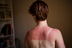 bad sunburn