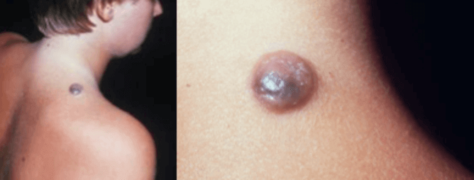 Nodular melanomas are fast-growing and aggressive