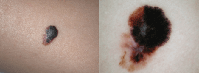 Asymmetry and colour variation typical of melanoma Spurce The Conversation