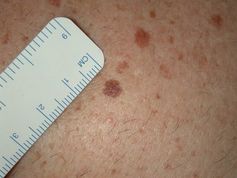 Symmetry and consistent colour of benign moles. Spurce: The Converstaion
