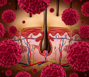 PREDICT-ID Melanoma Source: Melanoma News Today