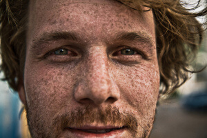 f you’re at high risk of skin cancer, check your skin regularly Source: The Conversation
