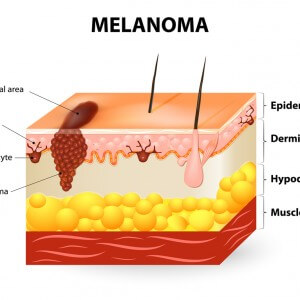 Source: Melanoma News Today