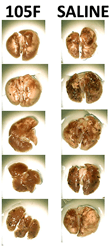 Lung metastisis