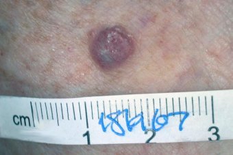 Photo: New or changing moles should be seen by a GP, experts say. (Supplied)  Source: ABC.net