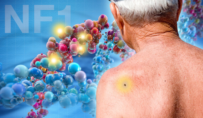 NF1-and-skin-cancer-1-2