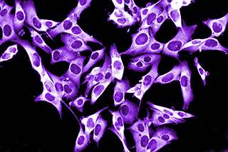 T cells from patients with melanoma can trigger a protective immune response against the disease.