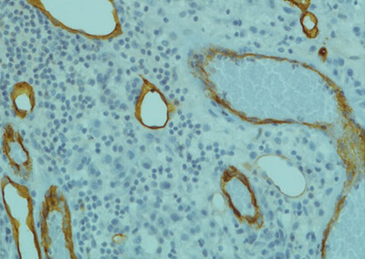 evealed: Intra-lesion micro-vessels. Source:Optics.com