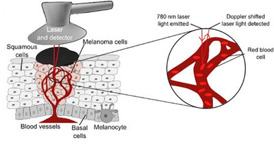 Laser Doppler probe is placed over a skin malignant melanoma.  Source: Optics.com