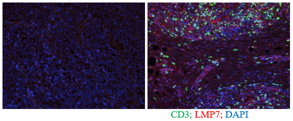 Figure 1 – Proteasome expression and T cells1. We stained two different biopsy samples from a single patient. We found that when T cells were present within the tumour (shown in green) a certain kind of immune-proteasome was also detected (LMP7, shown in red). When this immune proteasome was not present there were also no T cells within the tumour.