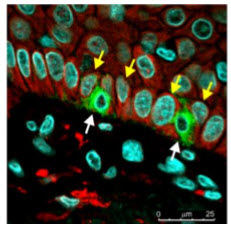 Lack of expression of MDM4 protein (red color) in normal melanocytes (green color) in the skin. In contrast, MDM4 is more strongly expressed in melanomas and inhibits the tumor-preventing actions of p53.