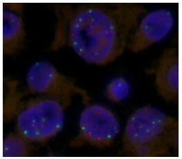 Mutations in the cells (blue circles) of a melanoma brain metastasis, causing amplification of the Myc gene (red dots, normally there are 2 per cell)