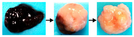 Understanding melanoma evolution during disease progression_2016